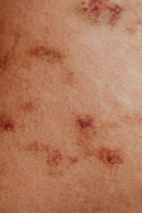 Infekcije kože: kada je crvenilo potrebno liječiti antibiotikom